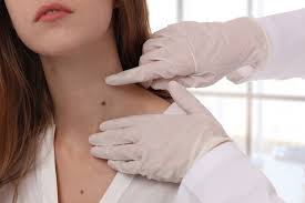 5 علامات تحذيرية لأكثر أنواع سرطان الجلد الشائعة